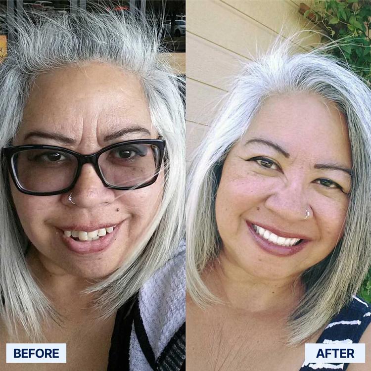 🎁🌎Ends Today: 70% OFF! Yagoo™ Medical Full Denture with Strong Suction^ 🏆 2026 Best Seller