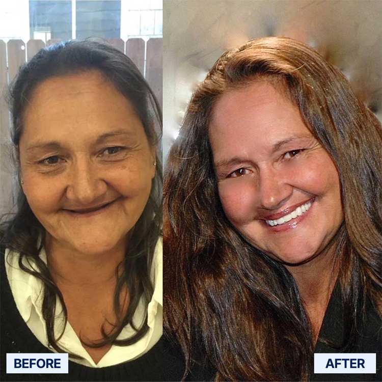 🎁🌎Ends Today: 70% OFF! Yagoo™ Medical Full Denture with Strong Suction^ 🏆 2026 Best Seller