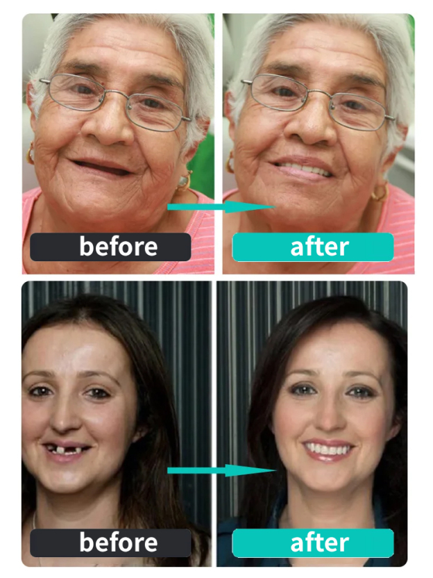 Denture modification kit