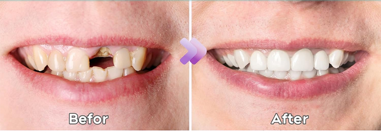 🎁🌎Ends Today: 70% OFF! Yagoo™ Medical Full Denture with Strong Suction^ 🏆 2026 Best Seller