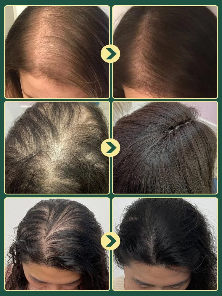 【⚡14 Days to Healthy Scalp】Strengthens hair, prevents hair loss and breakage 🍃 Pure plant-based formula ✅ Gentle and non-irritating, refreshing and oil-controlling 🌟 For thicker and fuller hair.