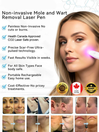 🤫The low-cost secret beauticians don't want you to know: Laser mole removal pen! ✨