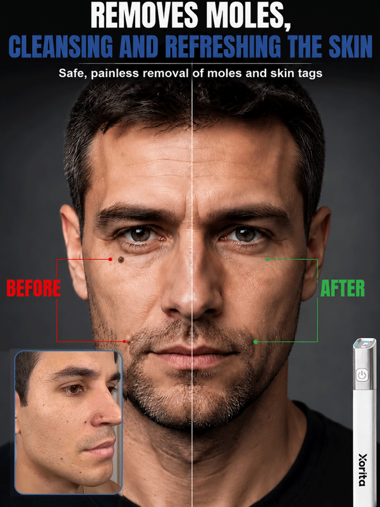  🚀 Medical Plasma Tech: 1 Session to Flawless Skin, No more skin tags!