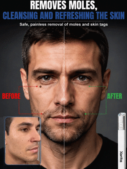  🚀 Medical Plasma Tech: 1 Session to Flawless Skin, No more skin tags!