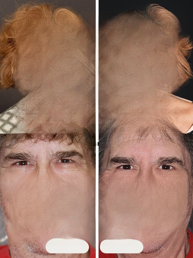 Natural Smile Customized Braces: A New Choice for Invisible Orthodontics, the Ultimate Solution for Dental Problems.