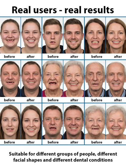 The Future of Dental Repair: No Clinic Visits, Perfectly Fitting Ultra-Comfortable Full Dentures.