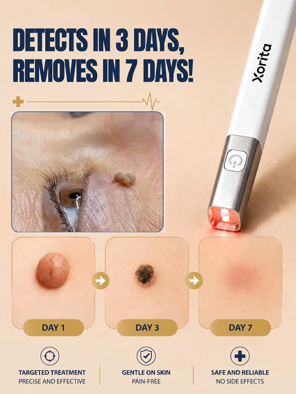 🚀 Medical Plasma Tech: 1 Session to Flawless Skin, No more skin tags!