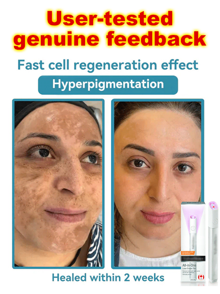 🤫The low-cost secret beauticians don't want you to know: Laser mole removal pen! ✨