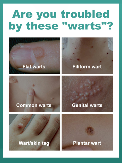 🤫The low-cost secret beauticians don't want you to know: Laser mole removal pen! ✨