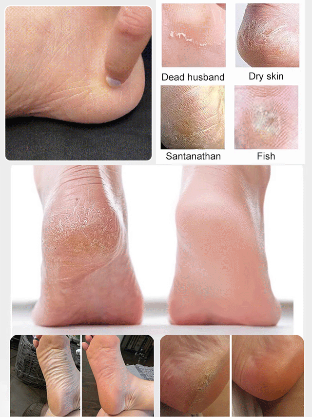 ✨🦶 Say goodbye to dry, rough heels! ✨Discover our innovative machine that purifies and softens the soles of your feet. No more suffering or hiding your feet—give them the care they deserve.