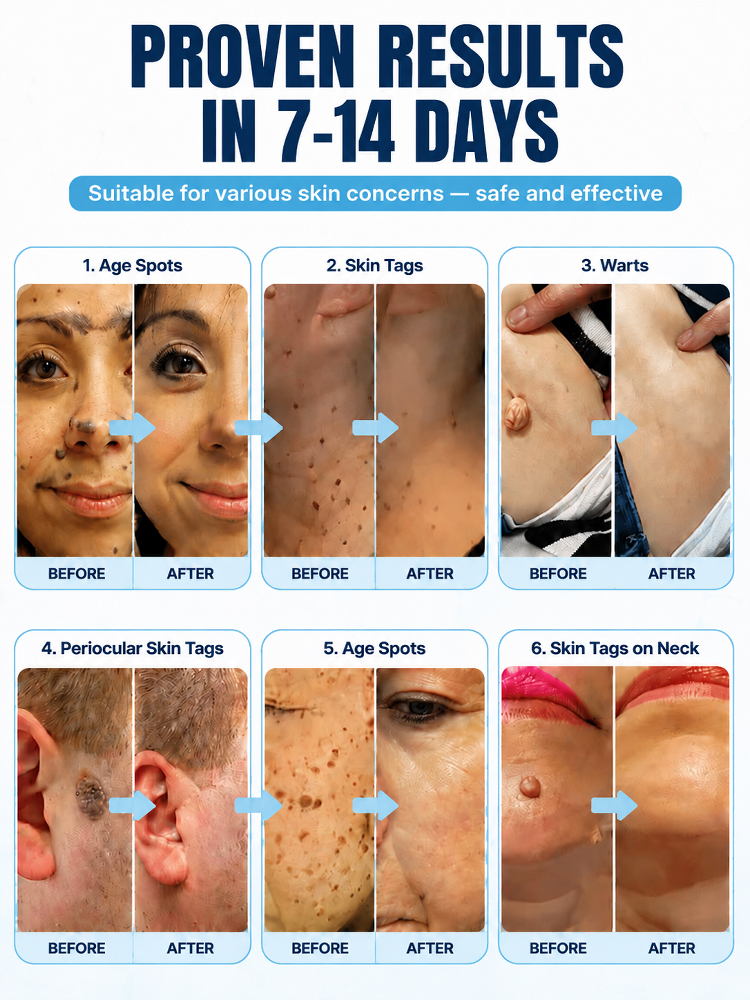  🚀 Medical Plasma Tech: 1 Session to Flawless Skin, No more skin tags!