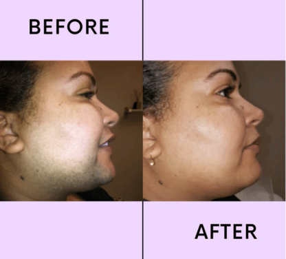 💖LAST DAY 50% OFF-🔥Hair Removal Kit