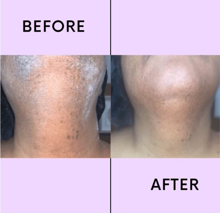💖LAST DAY 50% OFF-🔥Hair Removal Kit