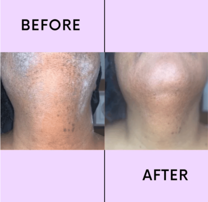 💖LAST DAY 50% OFF-🔥Hair Removal Kit