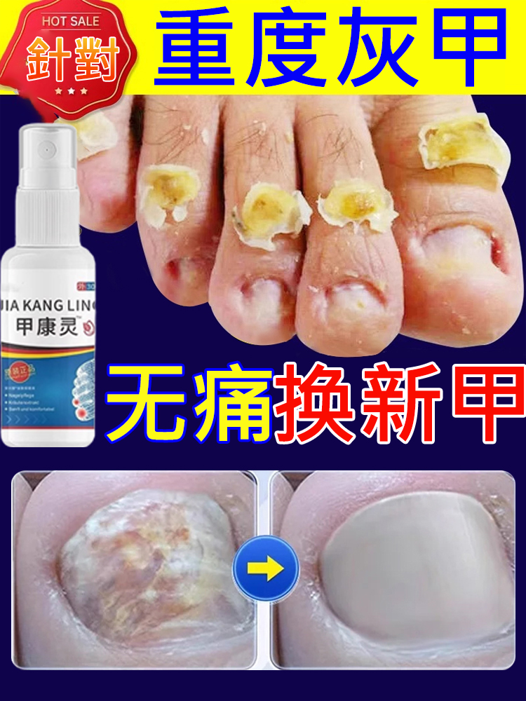 【3天去灰甲】甲康靈