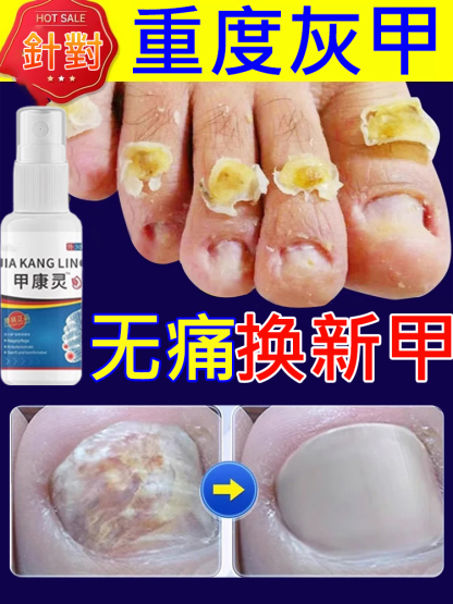 【3天去灰甲】甲康靈