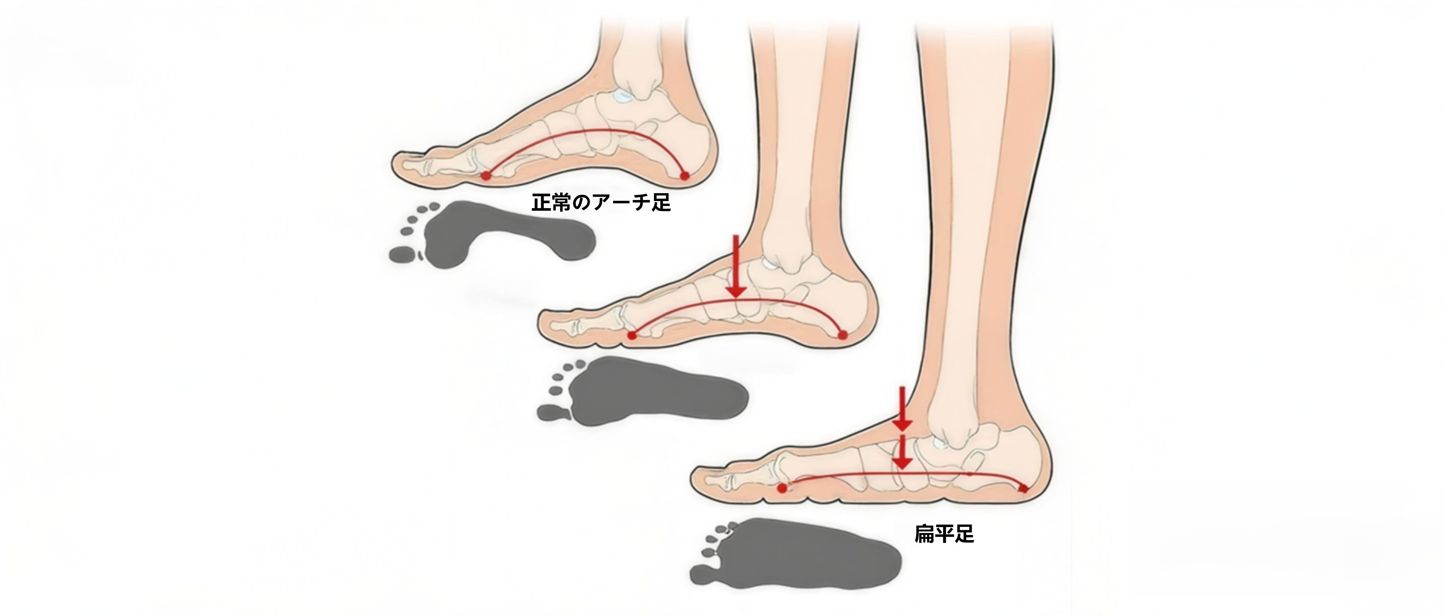 3ステップで自己診断：あなたの足アーチの状態を本当に理解していますか？ | emiwalk