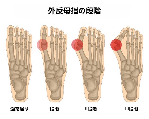 外反母趾の進行段階チェック-段階別症状