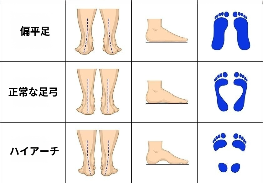 足アーチ診断図解