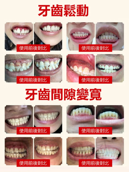 生物活性玻璃修護牙膏🦷 專效修護琺瑯質，幫助強韌琺瑯質，減少琺瑯質脆弱問題