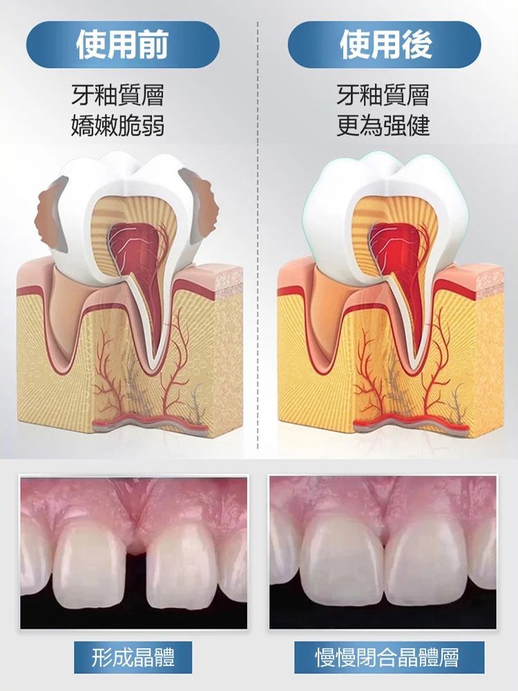 生物活性玻璃修護牙膏🦷 專效修護琺瑯質，幫助強韌琺瑯質，減少琺瑯質脆弱問題