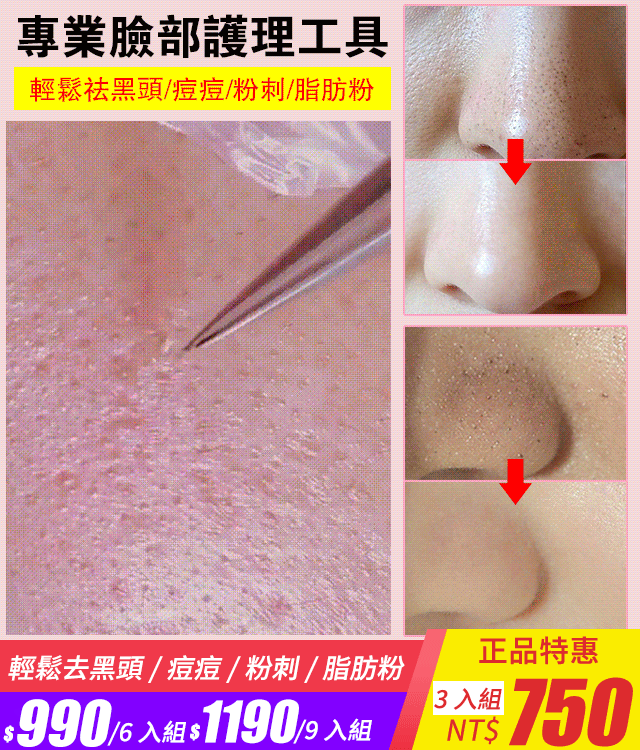 🪡不鏽鋼粉刺黑頭夾🧰直嘴、145° 斜嘴、128° 彎鉤，覆蓋全臉清潔需求