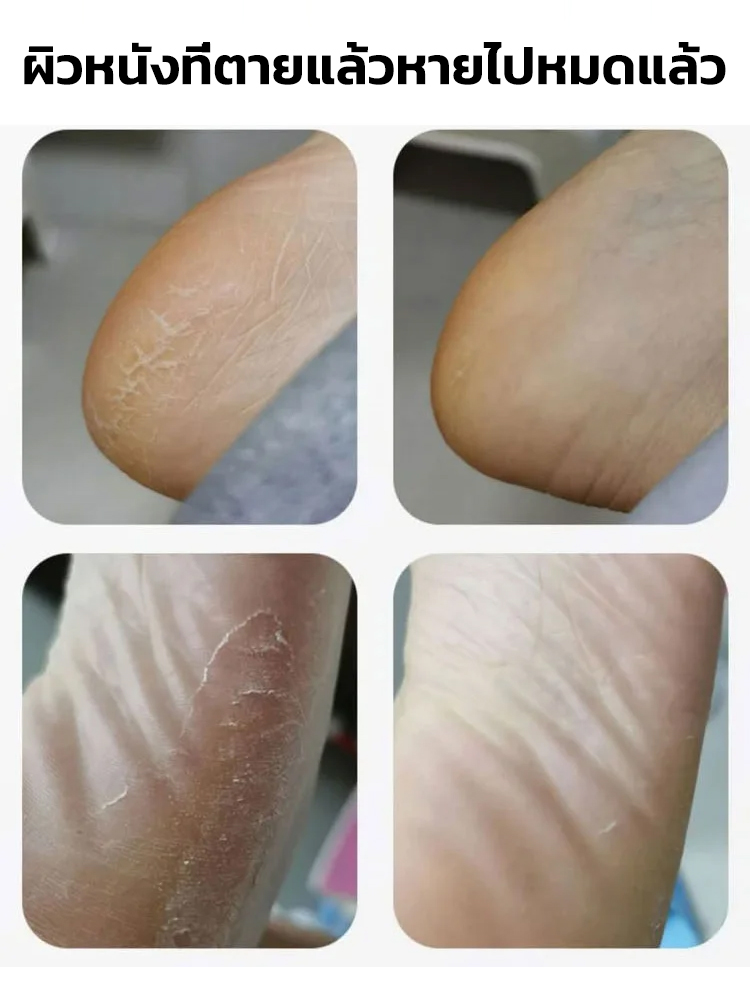 ฟื้นฟูเท้า ✨ บอกลาความหยาบกร้าน ให้เท้าของคุณเนียนนุ่มด้วยการนวดเพียงครั้งเดียว 🦶