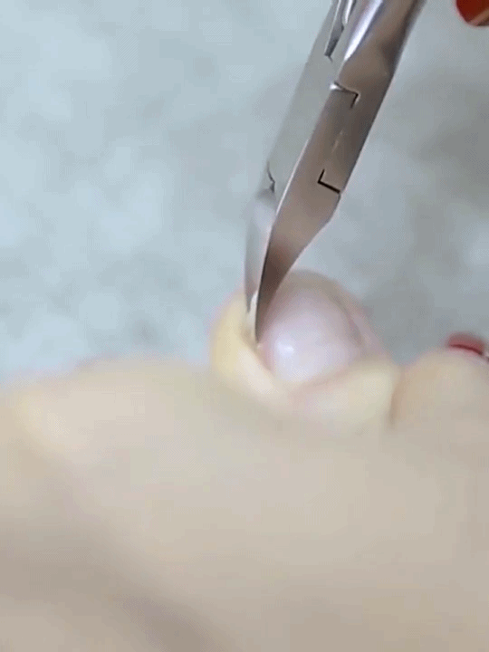 1636450462722256.gif 11-9孙雨航-新马设计(荆铭)-577121甲沟炎修甲2021119172843.gif