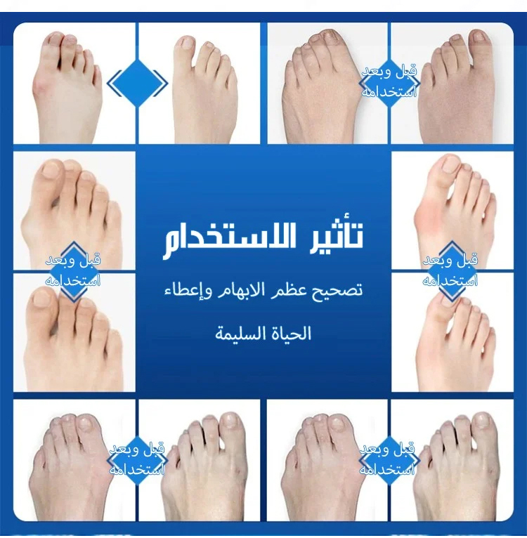 تصميم مريح لمقوم أصابع القدم