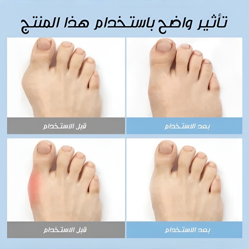Healthy-foot أحذية نسائية لتصحيح بروز إبهام القدم. يمكن تعديل عرض وارتفاع الحذاء لتصحيح المشية. مناسب لمن يعانون من مشاكل في القدم أو من يحتاجون لجراحة في القدم-healthy-foot