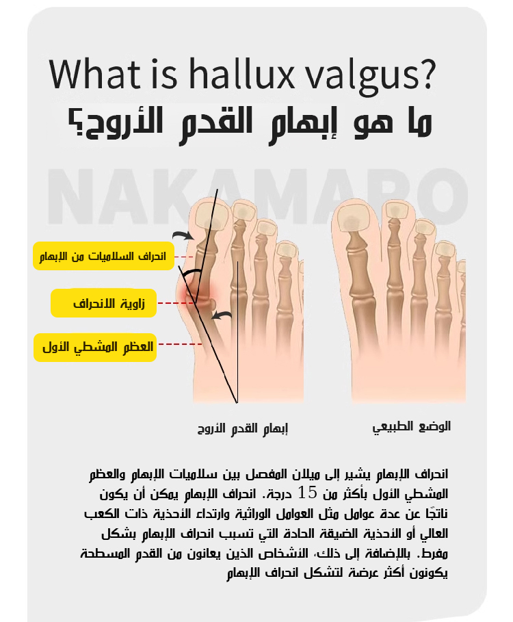 مقوم انحراف أصابع القدم لعلاج الانحراف
