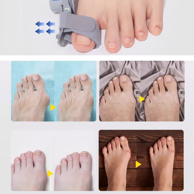 Healthy-foot مقوم انحراف أصابع القدم (تحسين الحالة في غضون 28 يوما)