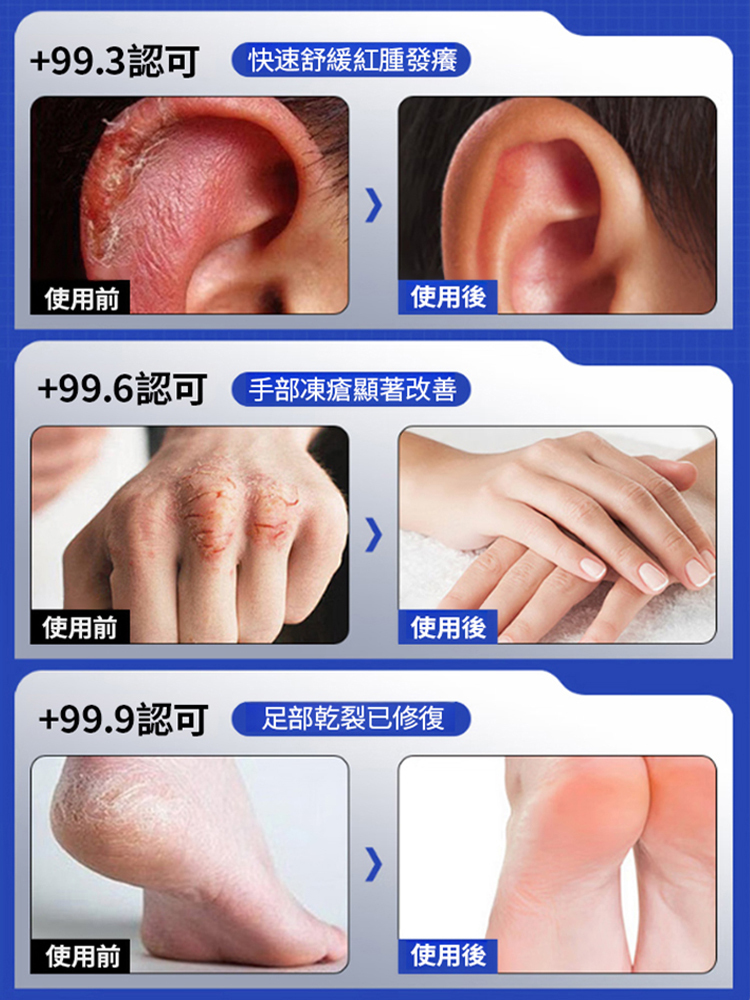 【當天癒合】手足精華乾裂貼，防水不掉🔥80W + 病人實證 當天舒緩紅腫
