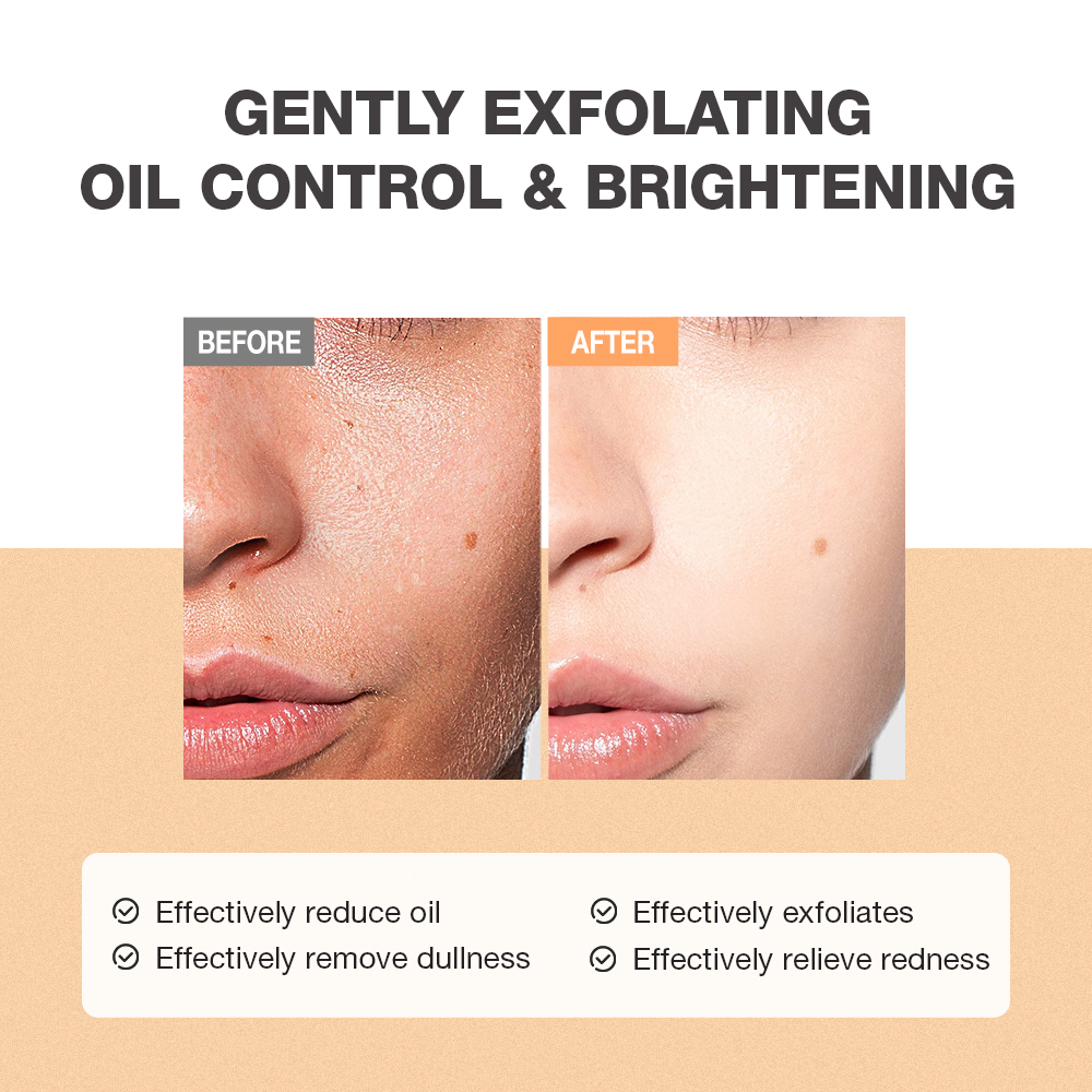 Full Acne & Whitening Therapy Kit-SKINEVER PH