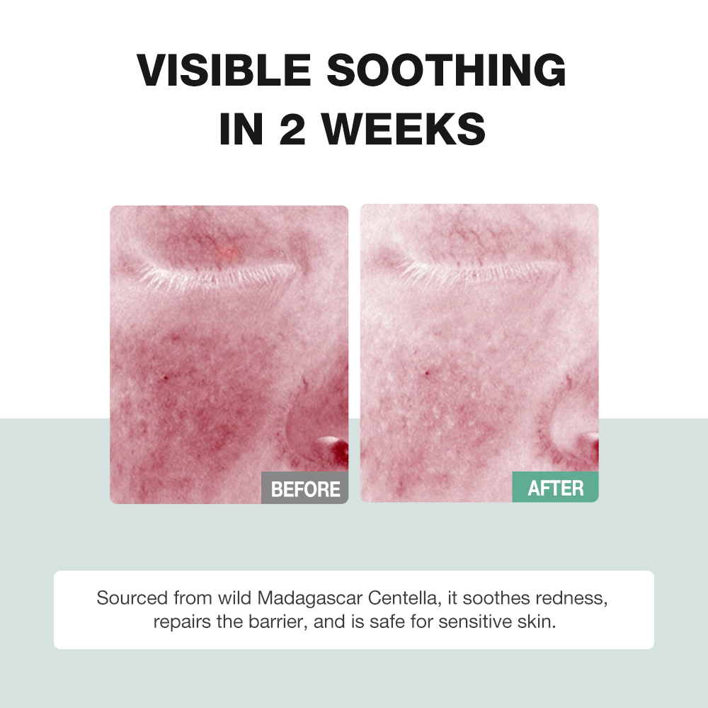 Centella Asiatica Soothing Essence-SKINEVER PH
