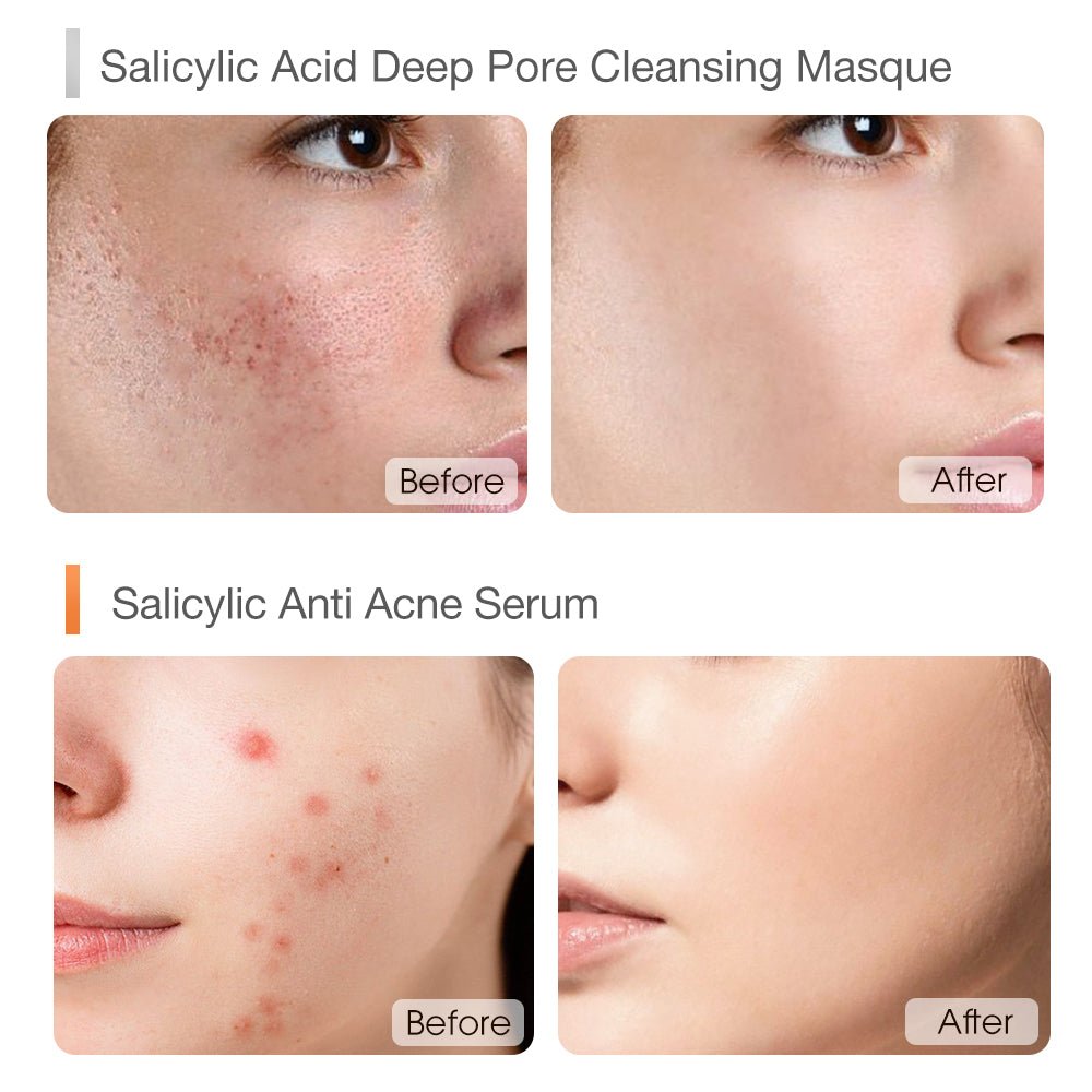 Deep Cleansing Acne Treatment Set-SKINEVER PH