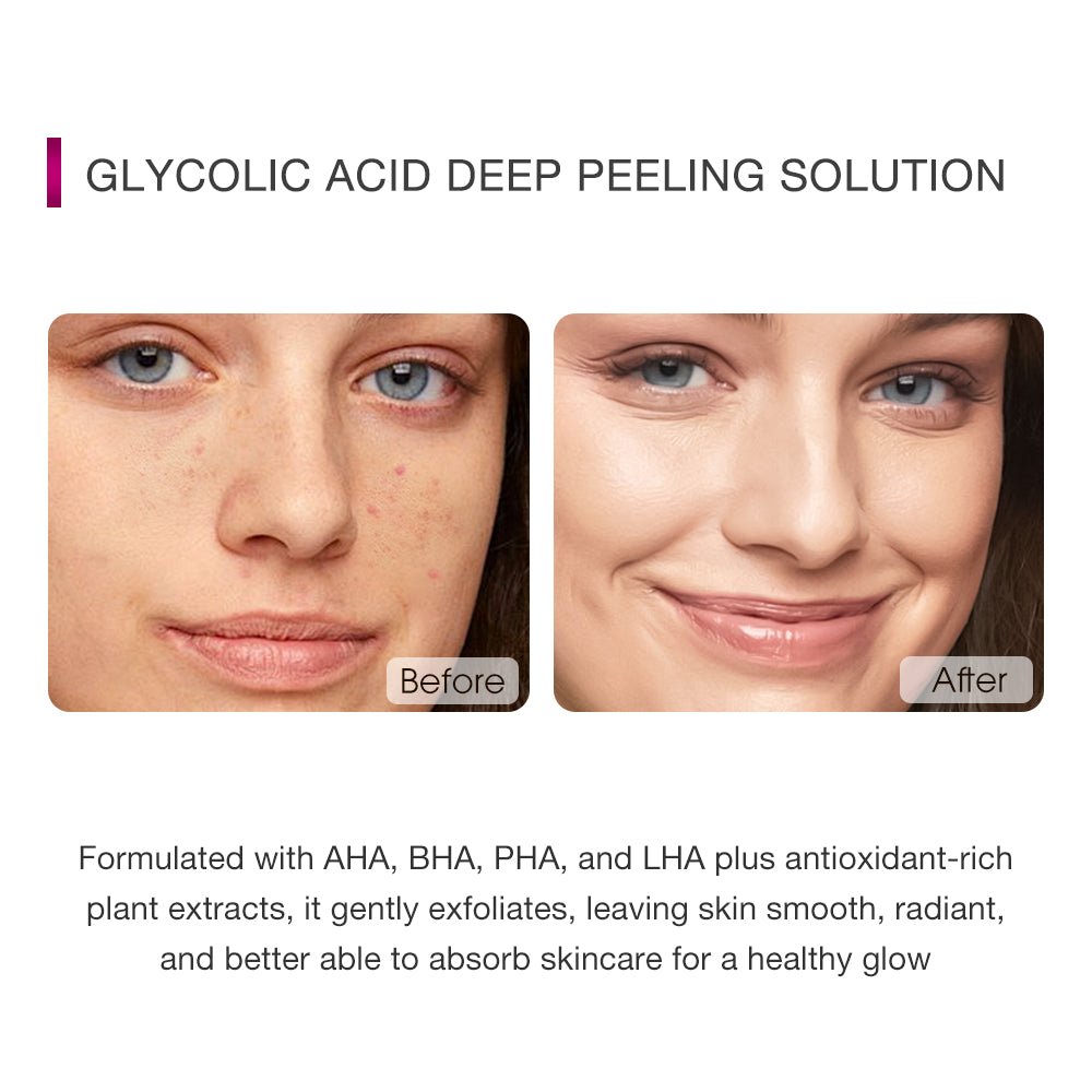 Glycolic Acid Exfoliating Essence-SKINEVER PH