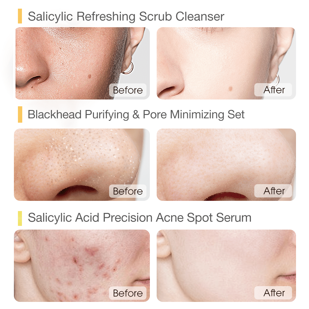 Salicylic Acid Acne and Blackhead Removal Set-SKINEVER PH