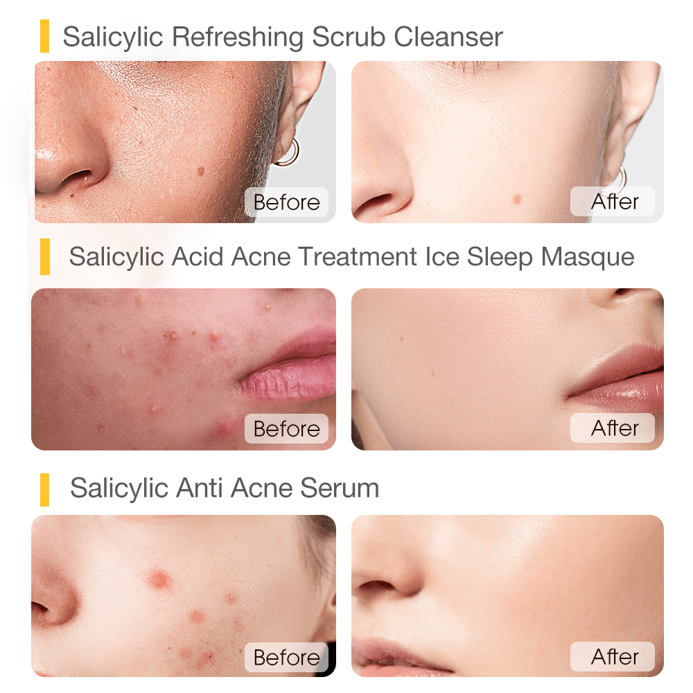 Triple Deep Acne Clearing Set-SKINEVER PH