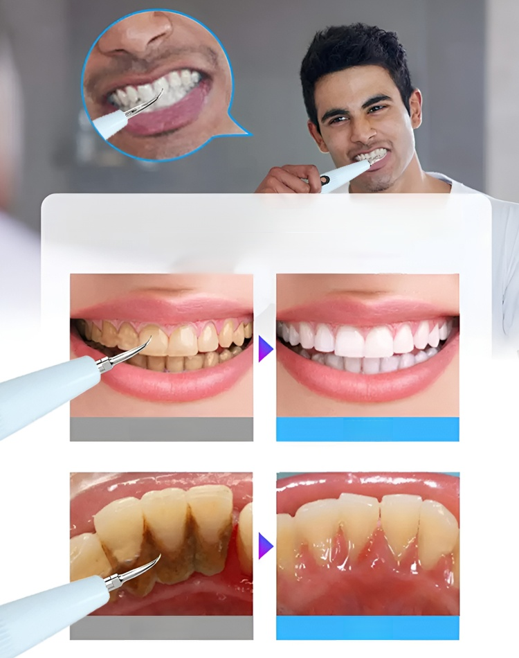 【Remove dental plaque】Ultrasonic electric toothbrush