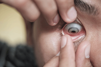 Eye Hygiene with Contact Lenses