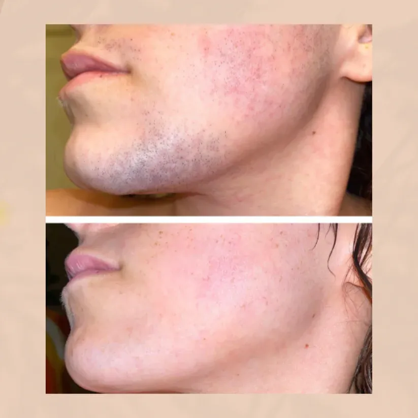 🌟LAST CHANCE! SPRING SALE🌟 Hair Removal Kit for Women - 🔥Buy 1 Get 1 Free🔥