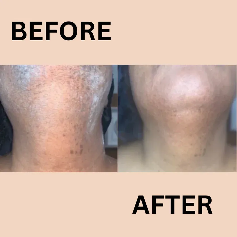 🌟LAST CHANCE! SPRING SALE🌟 Hair Removal Kit for Women - 🔥Buy 1 Get 1 Free🔥