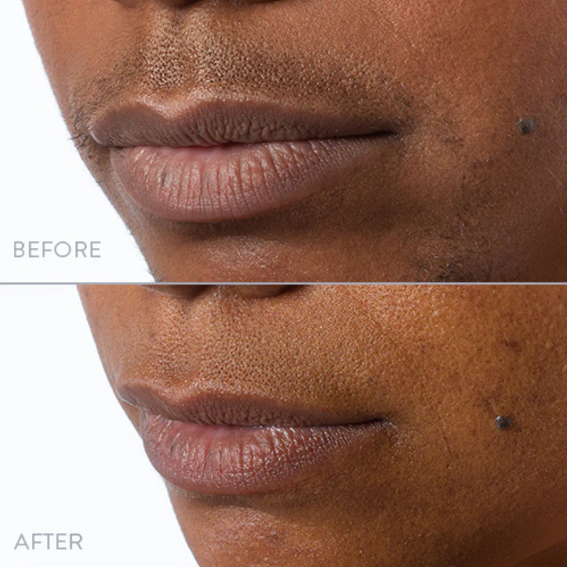 🌟LAST CHANCE! SPRING SALE🌟 Hair Removal Kit for Women - 🔥Buy 1 Get 1 Free🔥