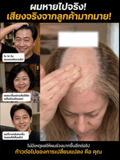 👑【ปลุกรากผมของคุณในเวลาเพียง 7 วัน!? เจลบำรุงหนังศีรษะสูตรปฏิวัติวงการที่ช่วยเพิ่มปริมาณเส้นผมได้ถึงสามเท่าอย่างน่าทึ่ง แก้ปัญหาผมบางและศีรษะล้านได้ทันที!】