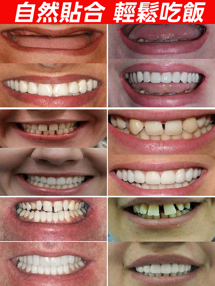 【美國製造，FDA認證】訂製全口義齒套裝