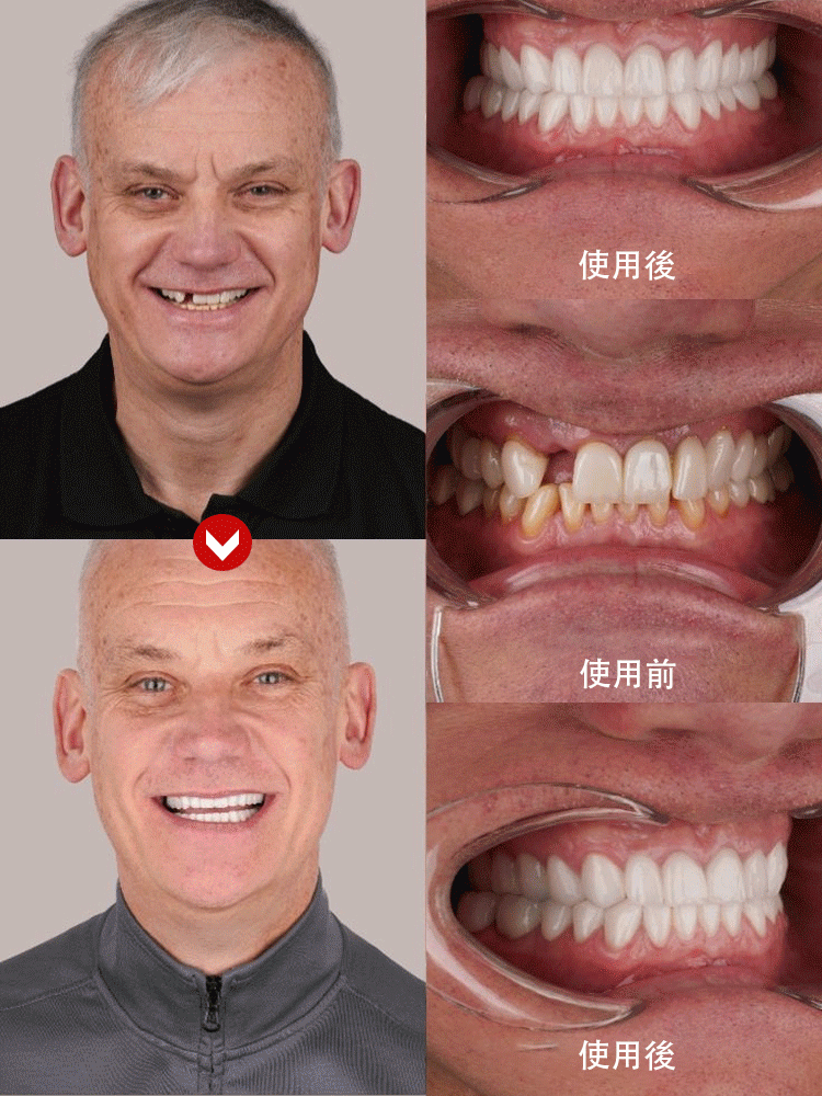 全口天然舒適牙齒美白器【FDA認證】