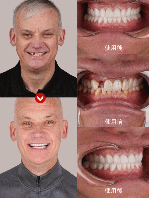 全口天然舒適牙齒美白器【FDA認證】