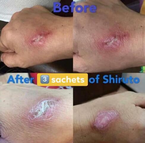 BELIXZ SHIRUTO 免疫系统维生素SHI-RU-TO Vitamin Immune system 免疫系統救星 (1g*30sach）