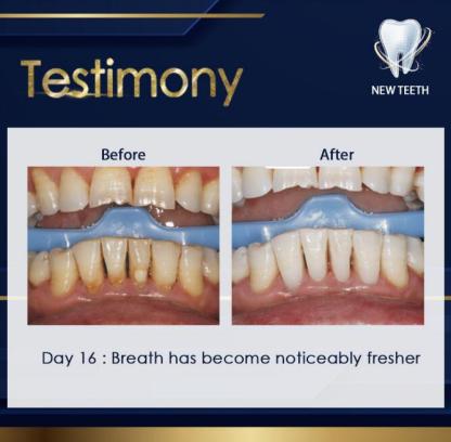 ✅Ready Stock✅[new teeth神龈粉 New Teeth | Teeth Whitening Tooth Powder Antibacteria